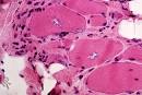 Inflammatory myopathies