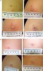 ScienceDirect.com - Vaccine - Clinical and immunologic responses ...
