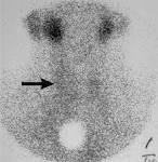 Subacute <b>thyroiditis</b> in a