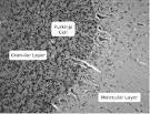 Cerebellar Abiotrophy