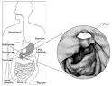 What I need to know about Peptic Ulcers - National Digestive ...