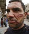 Photo: REUTERS/Ali Jasim - man_wounded