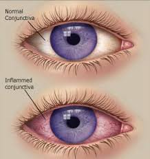 6 Tips to Treat Conjunctivitis