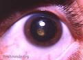EyeRounds.org: Search Online Ophthalmic Atlas
