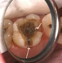 Clawson Dental - Family, Cosmetic &amp; Implant Dentistry - Cracked Teeth