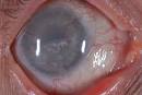 Corneal Transplant