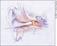 <b>Otitis Externa</b>: A Practical
