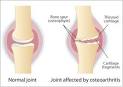 What is <b>Osteoarthritis</b>?
