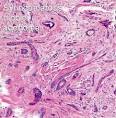 Nipple adenoma