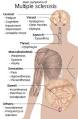 Multiple <b>sclerosis</b> signs