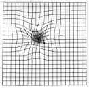 <b>macular degeneration</b>.