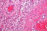 File:<b>Churg</b>-<b>Strauss syndrome</b>