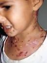 Linear IgA bullous dermatosis: