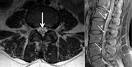 French Woman Develops Guillain-Barre Syndrome After H1N1 Swine Flu ...
