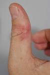 File:Daumen <b>infektion</b>.jpg