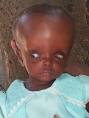Hydrocephalus Hydrocephalus-3 – Find Me A Cure
