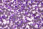 File:<b>Diffuse</b> large B cell