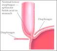 Barrett's Esophagus | ACG Patients