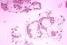 Muscular dystrophy: how could stem cells help? | Europe's stem ...