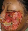 Flesh Eating Bacteria is Coming to a Town Near You! | Northern ...