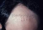Androgenic Alopecia Men Photo - Skin Disease Pictures