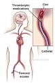 the <b>thrombolytic therapy</b>,