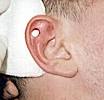 Dermal Punch - BME Encyclopedia