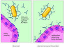 Autoimmune Disorder