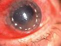 <b>corneal edema</b>, <b>corneal</b>