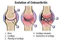 <b>osteoarthritis</b>