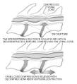 Wobbler Syndrome