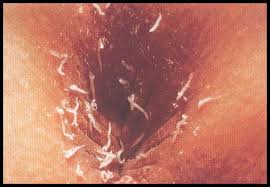 Pinworms Itching