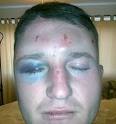 tommy%20robinson%20beaten.jpg