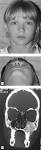 Fibrous dysplasia of the