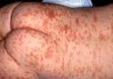 Vesicular-bullous rash (Assessment of) - Resources - Images - Best ...