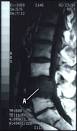 Spinal Tumors and Back Pain