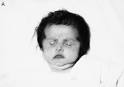 <b>syndrome</b> appearance of