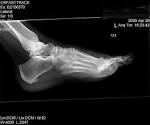 The X-Rays « So You've Got a LISFRANC INJURY!