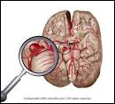 Diagnosis of Brain Aneurysms « Patients Crossing Oceans
