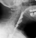 Understanding the Modified Barium Swallow Study