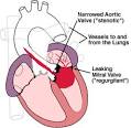 HeartPoint: Endocarditis