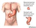 <b>Gastrointestinal Bleeding</b> | Wake Gastroenterology