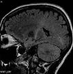 Amyotrophic lateral sclerosis - Wikipedia, the free encyclopedia