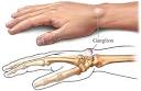 Andrea Harner: Ganglion Cyst Support Group?
