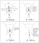 Female genital mutilation - Wikipedia, the free encyclopedia