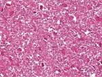 An Uncommon Presentation of Giant Cell Tumor