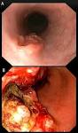 Who gets <b>oesophageal cancer</b>?