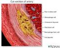 Atherosclerosis is a disease