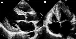 Image result for Fabry's disease echocardiography or ultrasound