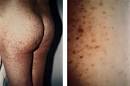 Cutaneous and Systemic Manifestations of Mastocytosis - June 1999 ...